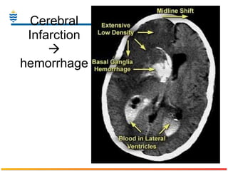 Cerebral Infarction   hemorrhage 