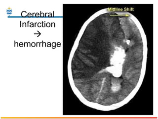 Cerebral Infarction   hemorrhage 