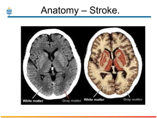 Anatomy – Stroke.  