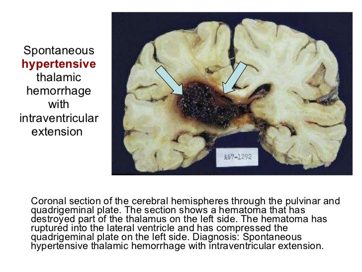 Pathology of StrokeCVA