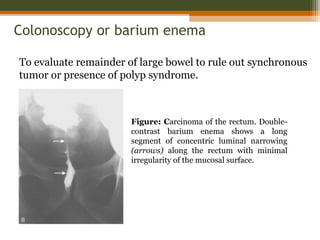 Colonoscopy or barium enema
Figure: Carcinoma of the rectum. Double-
contrast barium enema shows a long
segment of concentric luminal narrowing
(arrows) along the rectum with minimal
irregularity of the mucosal surface.
To evaluate remainder of large bowel to rule out synchronous
tumor or presence of polyp syndrome.
 