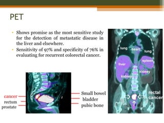 PET
• Shows promise as the most sensitive study
for the detection of metastatic disease in
the liver and elsewhere.
• Sensitivity of 97% and specificity of 76% in
evaluating for recurrent colorectal cancer.
cancer
rectum
prostate pubic bone
bladder
Small bowel
 
