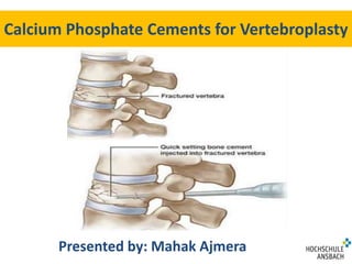 Calcium Phosphate Cements for Vertebroplasty 
Presented by: Mahak Ajmera 
 
