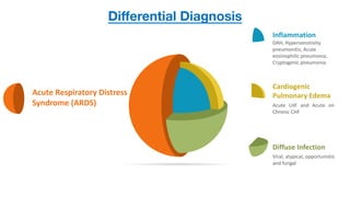 Differential Diagnosis
Acute	Respiratory	Distress	
Syndrome	(ARDS)
Viral,	atypical,	opportunistic	
and	fungal
Diffuse	Infection
Acute LHF and Acute on
Chronic CHF
Cardiogenic	
Pulmonary	Edema
Inflammation
DAH,	Hypersensitivity	
pneumonitis,	Acute	
eosinophilic	pneumonia,	
Cryptogenic	pneumonia
 