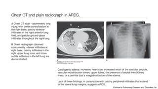 Chest CT and plain radiograph in ARDS.
A Chest CT scan - asymmetric lung
injury, with dense consolidation at
the right base, patchy alveolar
infiltrates in the right anterior lung
field, and patchy ground-glass
infiltrates throughout the right lung.
B Chest radiograph obtained
concurrently - dense infiltrates at
right base, patchy infiltrates in the
right upper lung zone, and more
subtle infiltrates in the left lung are
demonstrated.
Cardiogenic edema: increased heart size, increased width of the vascular pedicle,
vascular redistribution toward upper lobes, the presence of septal lines (Kerley
lines), or a perihilar (bat's wing) distribution of the edema.
Lack of these findings, in conjunction with patchy peripheral infiltrates that extend
to the lateral lung margins, suggests ARDS.
Fishman's Pulmonary Diseases and Disorders, 5e
 