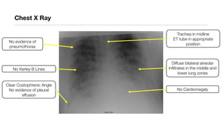 Chest X Ray
No Kerley B Lines
Diffuse bilateral alveolar
infiltrates in the middle and
lower lung zones
No Cardiomegaly
Clear Costophrenic Angle
No evidence of pleural
effusion
Trachea in midline
ET tube in appropriate
position
No evidence of
pneumothorax
 