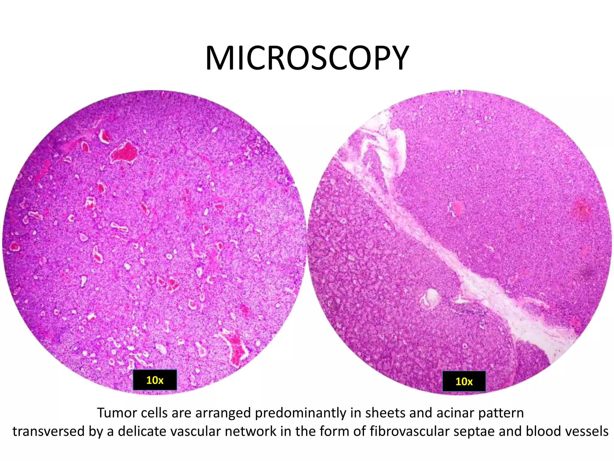 MICROSCOPY
Tumor cells are arranged predominantly in sheets and acinar pattern
transversed by a delicate vascular network in the form of fibrovascular septae and blood vessels
10x 10x