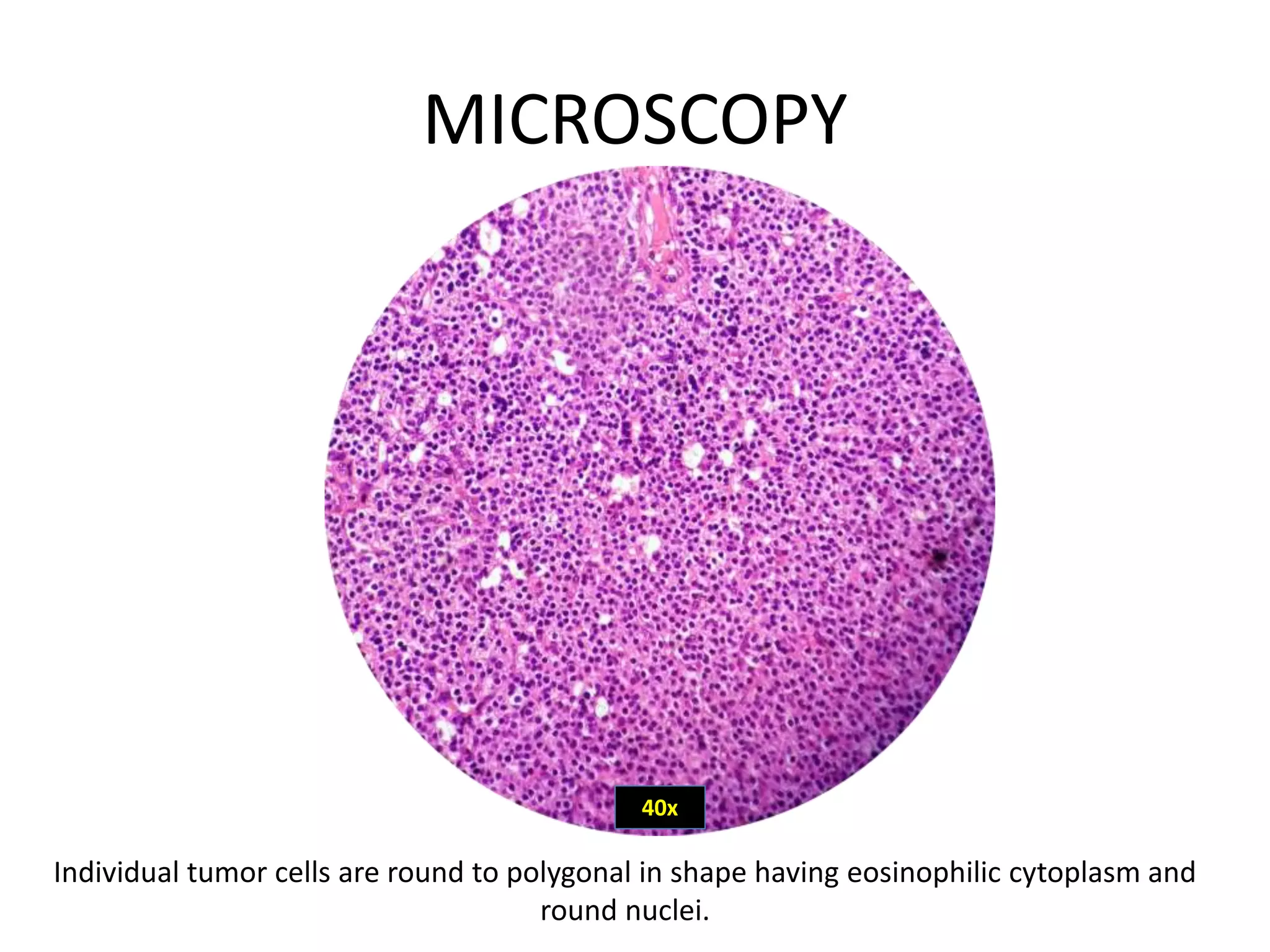 MICROSCOPY
Individual tumor cells are round to polygonal in shape having eosinophilic cytoplasm and
round nuclei.
40x