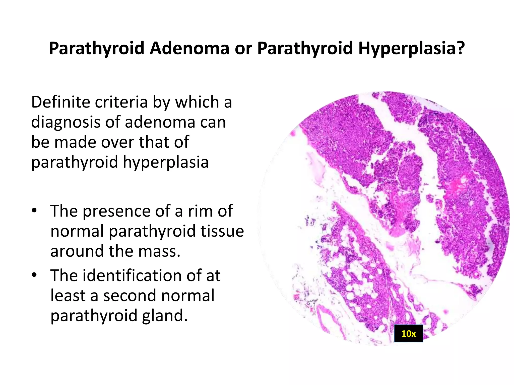 Parathyroid Adenoma or Parathyroid Hyperplasia?
Definite criteria by which a
diagnosis of adenoma can
be made over that of
parathyroid hyperplasia
• The presence of a rim of
normal parathyroid tissue
around the mass.
• The identification of at
least a second normal
parathyroid gland.
10x