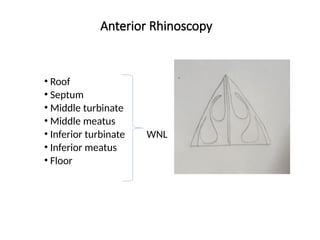 Anterior Rhinoscopy
• Roof
• Septum
• Middle turbinate
• Middle meatus
• Inferior turbinate WNL
• Inferior meatus
• Floor
 