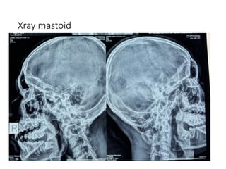 Xray mastoid
 