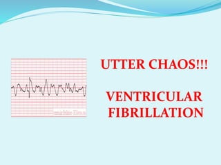 UTTER CHAOS!!!
VENTRICULAR
FIBRILLATION
 