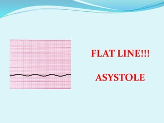 FLAT LINE!!!
ASYSTOLE
 