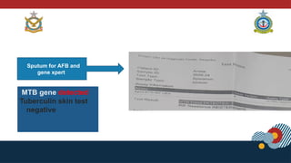 Sputum for AFB and
gene xpert
MTB gene detected
Tuberculin skin test
negative
 