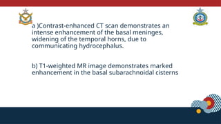 a )Contrast-enhanced CT scan demonstrates an
intense enhancement of the basal meninges,
widening of the temporal horns, due to
communicating hydrocephalus.
b) T1-weighted MR image demonstrates marked
enhancement in the basal subarachnoidal cisterns
 