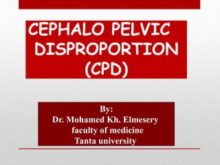 CEPHALO PELVIC
DISPROPORTION
(CPD)
By:
Dr. Mohamed Kh. Elmesery
faculty of medicine
Tanta university
 