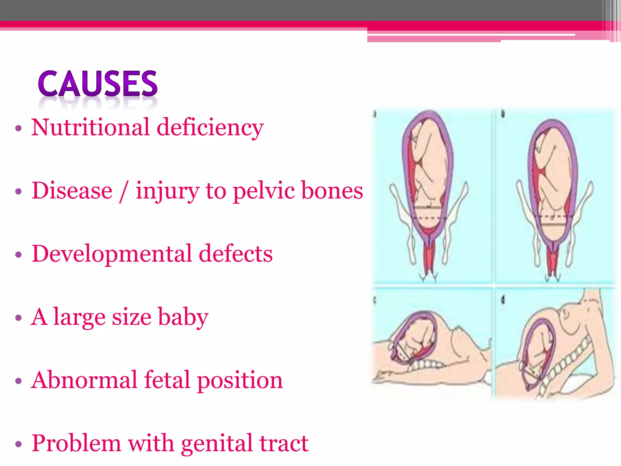 • Nutritional deficiency
• Disease / injury to pelvic bones
• Developmental defects
• A large size baby
• Abnormal fetal position

• Problem with genital tract

 