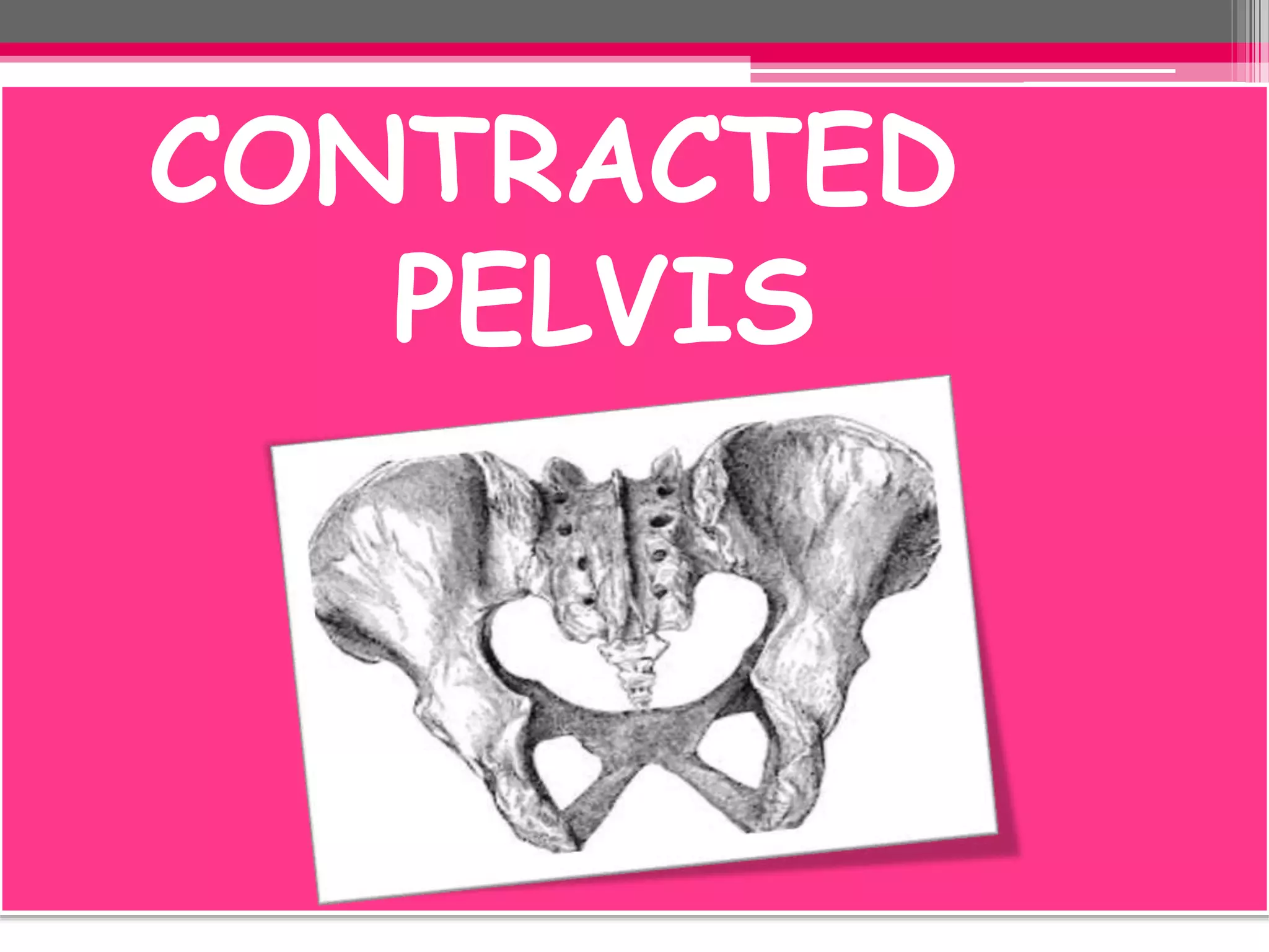 CONTRACTED
PELVIS

 