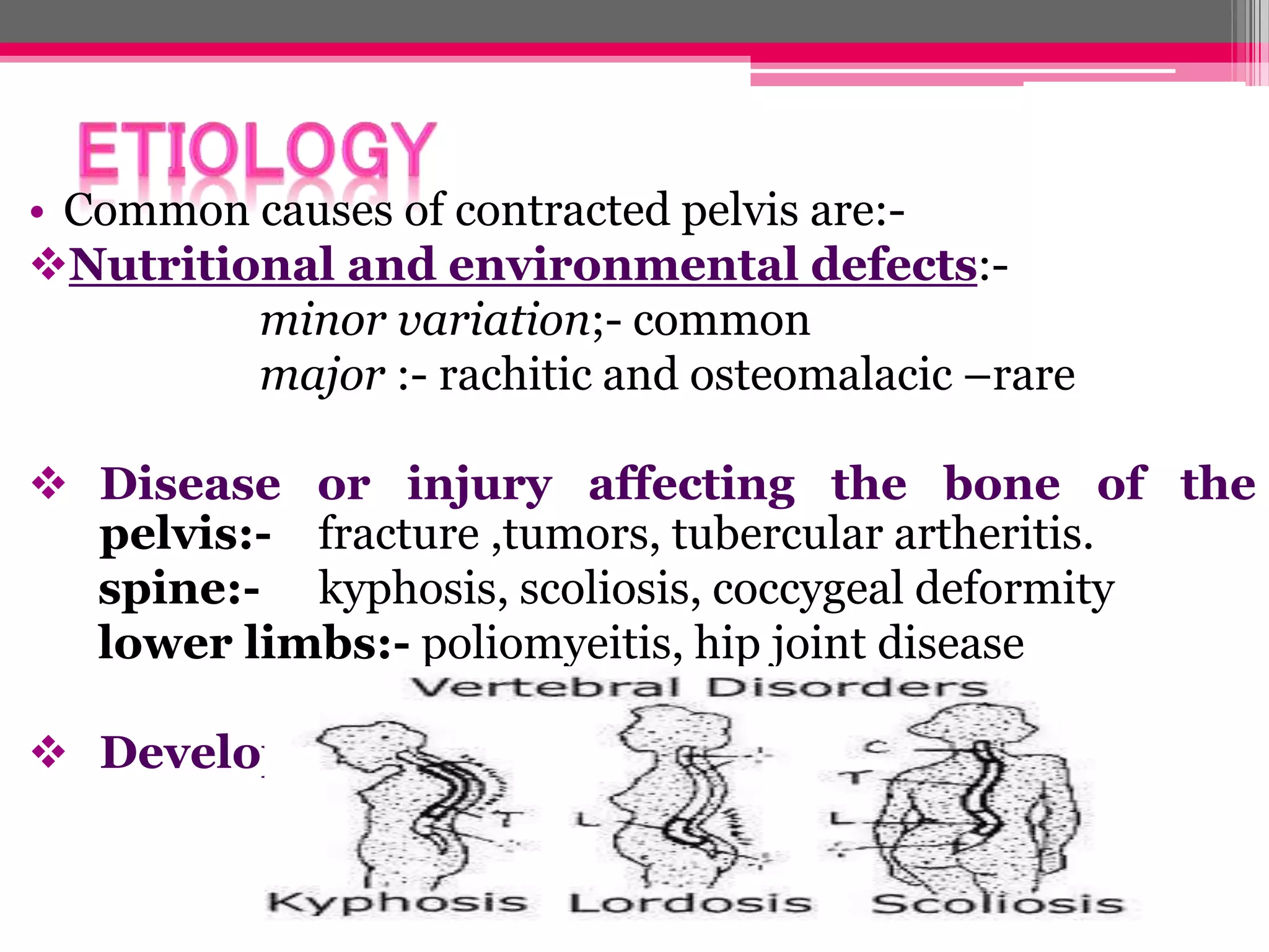 • Common causes of contracted pelvis are:Nutritional and environmental defects:minor variation;- common
major :- rachitic and osteomalacic –rare

 Disease or injury affecting the bone of the
pelvis:- fracture ,tumors, tubercular artheritis.
spine:- kyphosis, scoliosis, coccygeal deformity
lower limbs:- poliomyeitis, hip joint disease
 Developmental defects:- naegele’s pelvis,
robert’s pelvis

 