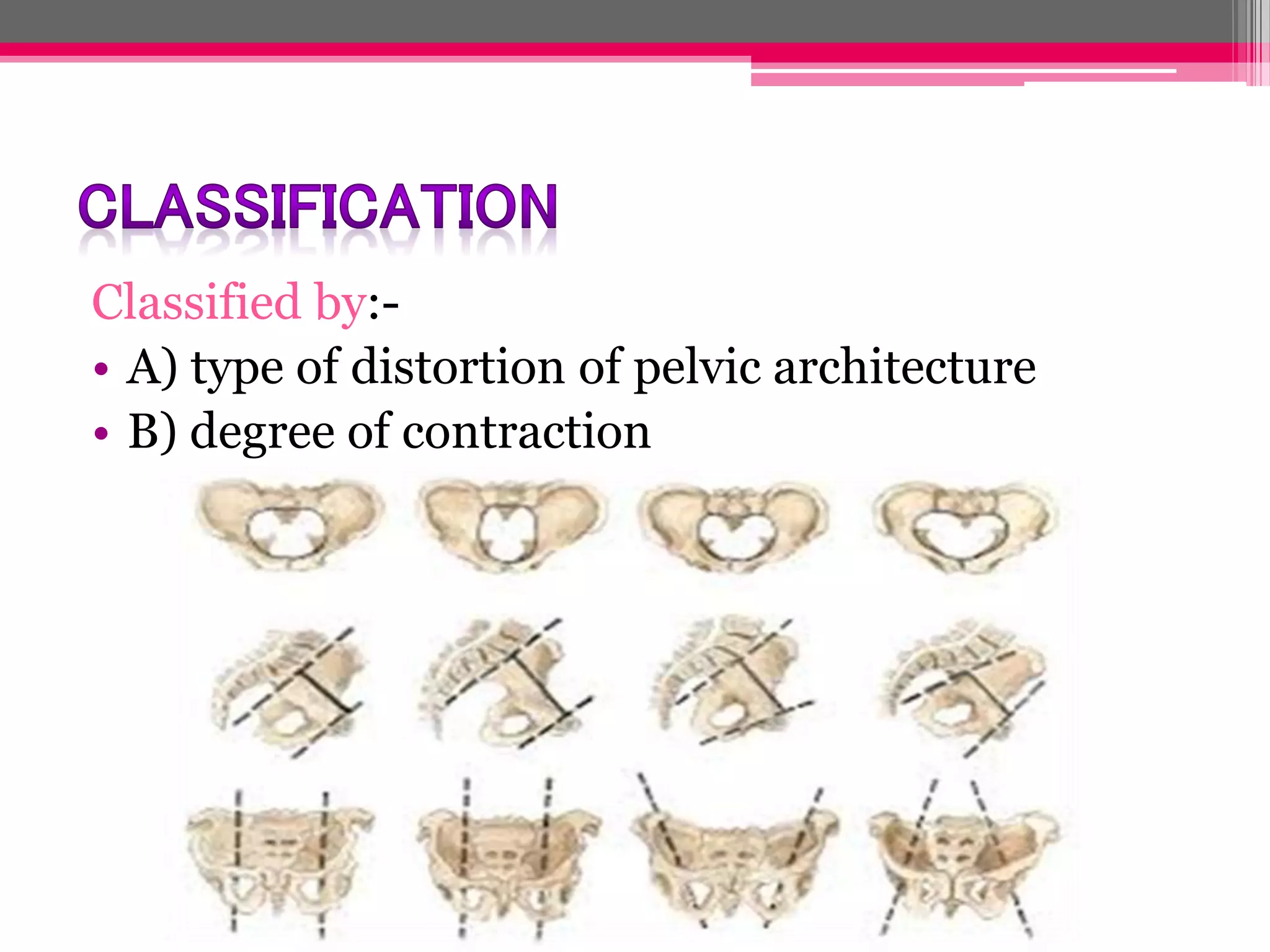 Classified by:• A) type of distortion of pelvic architecture
• B) degree of contraction

 