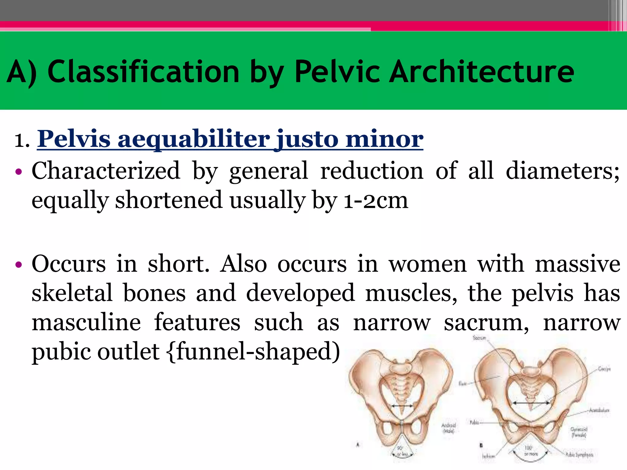 A) Classification by Pelvic Architecture
1. Pelvis aequabiliter justo minor
• Characterized by general reduction of all diameters;
equally shortened usually by 1-2cm
• Occurs in short. Also occurs in women with massive
skeletal bones and developed muscles, the pelvis has
masculine features such as narrow sacrum, narrow
pubic outlet {funnel-shaped)

 