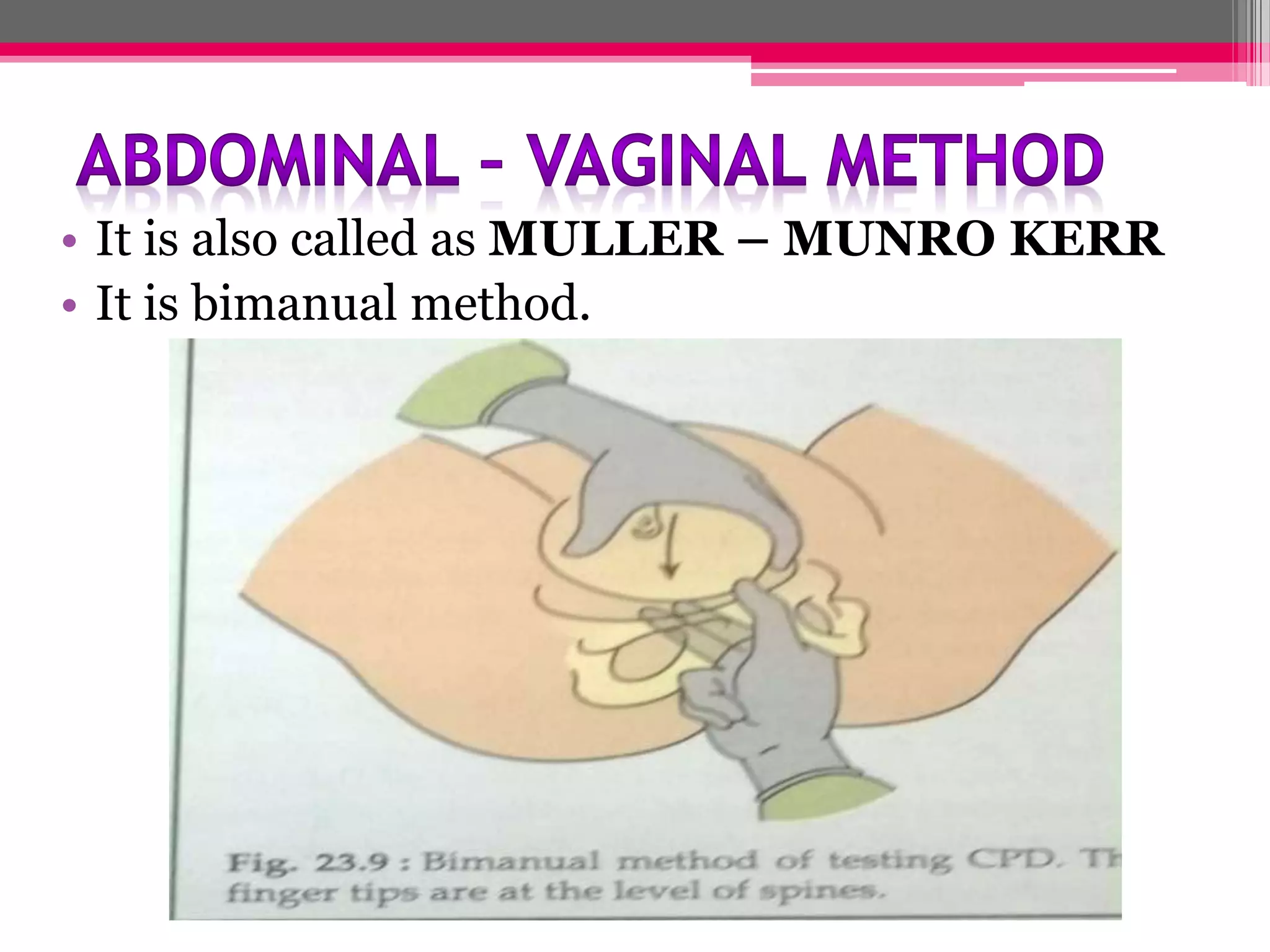 • It is also called as MULLER – MUNRO KERR
• It is bimanual method.

 