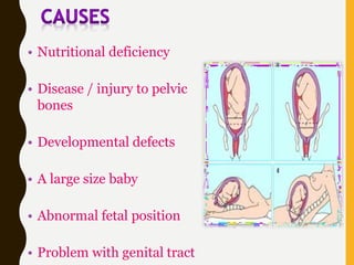 • Nutritional deficiency
• Disease / injury to pelvic
bones
• Developmental defects
• A large size baby
• Abnormal fetal position
• Problem with genital tract
 