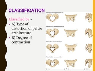 Classified by:-
• A) Type of
distortion of pelvic
architecture
• B) Degree of
contraction
 