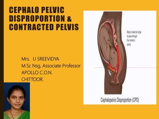 CEPHALO PELVIC
DISPROPORTION &
CONTRACTED PELVIS
Mrs. U SREEVIDYA
M.Sc Nsg, Associate Professor
APOLLO C.O.N.
CHITTOOR.
 
