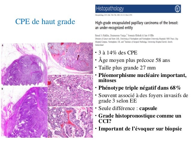 CANCER MAMMAIRE : Carcinome papillaire encapsulé CANCER MAMMAIRE : Carcinome papillaire encapsulé
