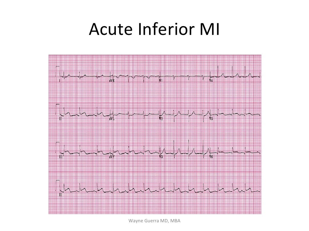 Chest Pain EMS Review