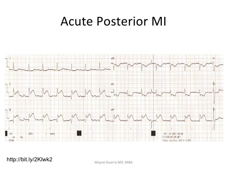 Chest Pain EMS Review