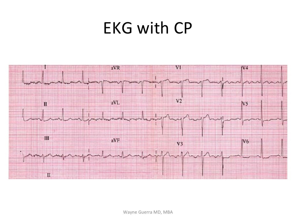 Chest Pain EMS Review