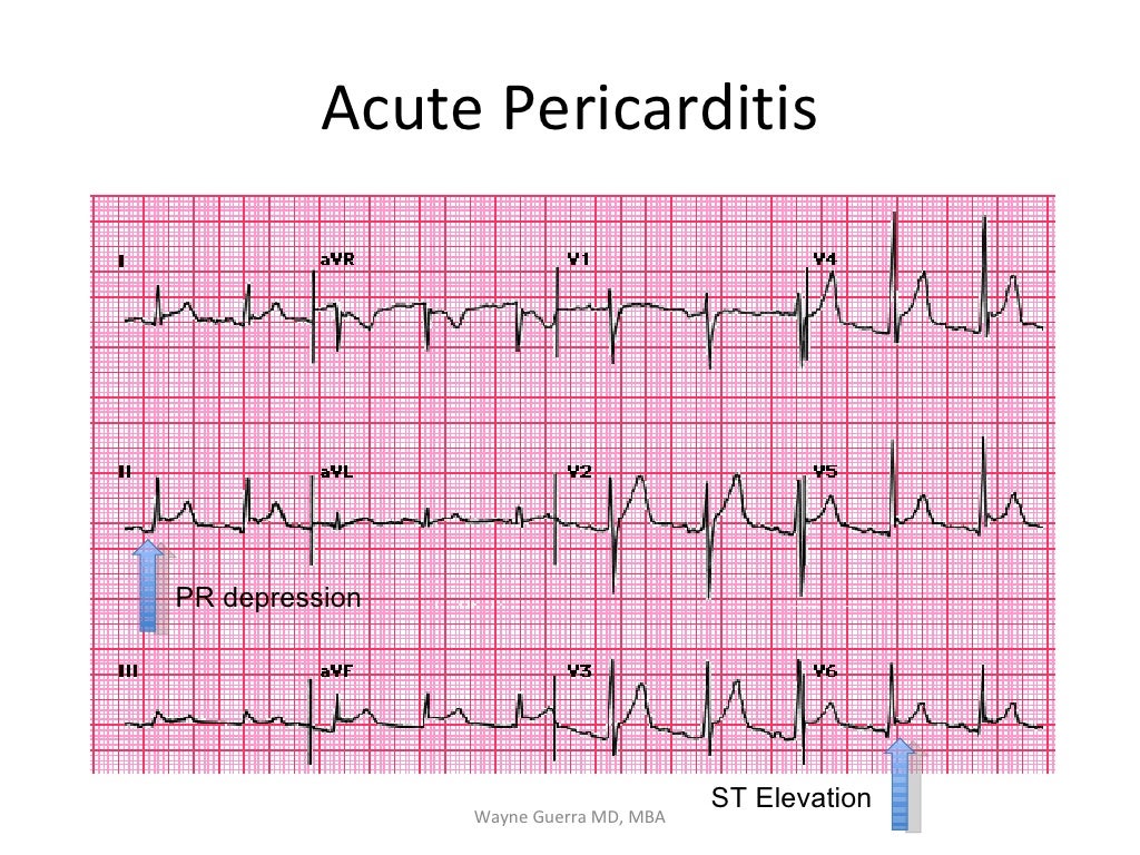 Chest Pain EMS Review