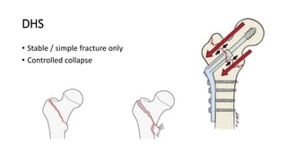DHS
• Stable / simple fracture only
• Controlled collapse
 