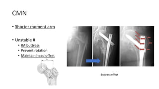 CMN
• Shorter moment arm
• Unstable #
• IM buttress
• Prevent rotation
• Maintain head offset
Buttress effect
 