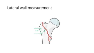 Lateral wall measurement
 