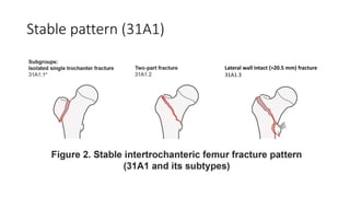 Stable pattern (31A1)
Lateral wall intact (>20.5 mm) fracture
31A1.3
 