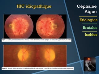 HIC idiopathique

Céphalée
Aigue
Etiologies
Brutales
Isolées

 