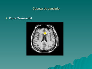 Cabeça do caudado Corte Transaxial 