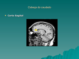 Cabeça do caudado Corte Sagital 