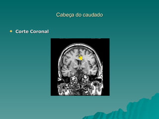 Cabeça do caudado Corte Coronal 
