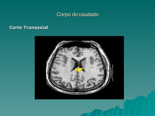 Corpo do caudado Corte Transaxial 