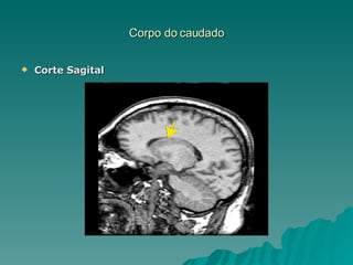 Corpo do caudado Corte Sagital 