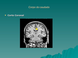 Corpo do caudado Corte Coronal 
