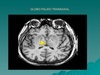 GLOBO PÁLIDO TRANSAXIAL 