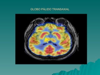 GLOBO PÁLIDO TRANSAXIAL 