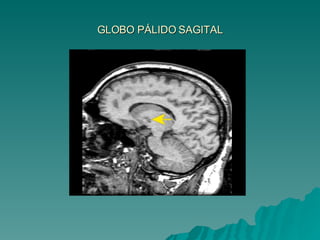 GLOBO PÁLIDO SAGITAL 