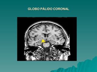 GLOBO PÁLIDO CORONAL 