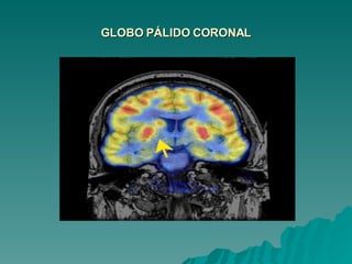 GLOBO PÁLIDO CORONAL 